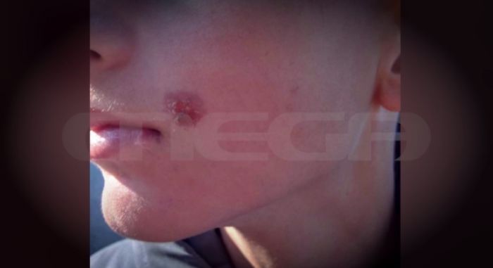 Άγριο bullying | Σοκάρει η επίθεση με τσιγάρο σε 14χρονο παιδί στην Πέλλα (vd)