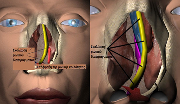 Σκολίωση ρινικού διαφράγματος