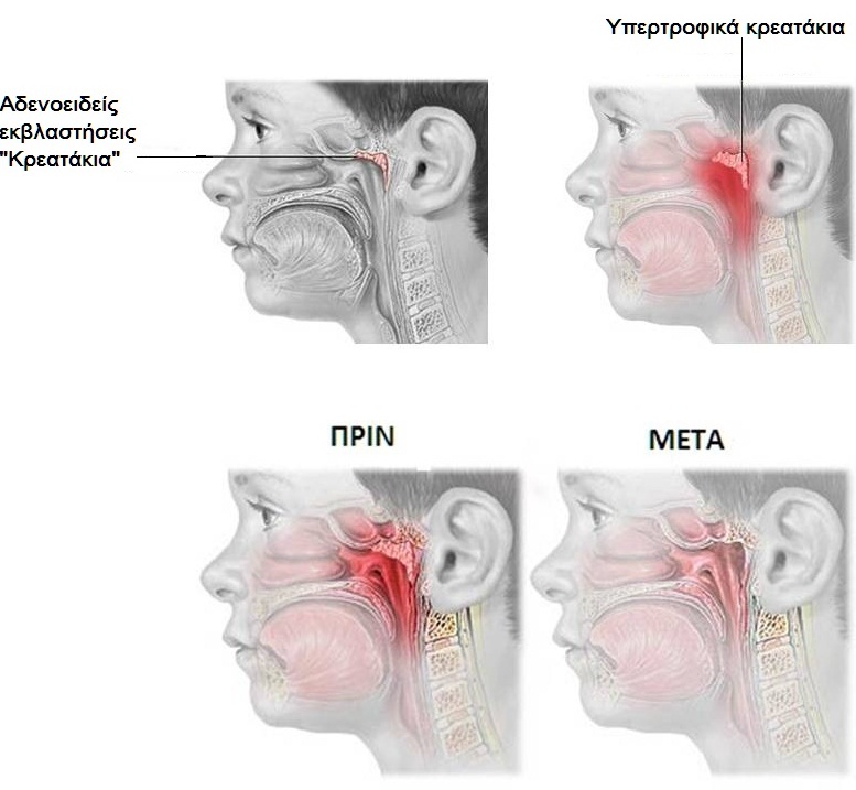 «Κρεατάκια» ή αδενοειδείς εκβλαστήσεις